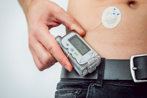 Man holding a continuous glucose monitor attached to closed loop system